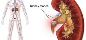 Kidney Stone Foods To Avoid..